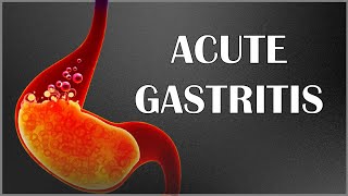 Acute Gastritis  Signs amp Symptoms Causes Pathogenesis Complications Diagnosis amp Treatment [upl. by Ayle186]