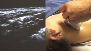 Ultrasound Guided Supraclavicular Nerve Block  SSRAUSAcom [upl. by Nerita]