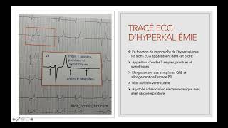 Flash ECG  Hyperkaliémie [upl. by Hobbie]