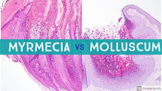 Molluscum vs Myrmecia Wart  Dermpath Lookalikes [upl. by Idnahs528]