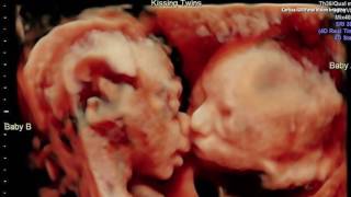 Ultrasound Captures Sweet Moment Between Twins in the Womb [upl. by Nyrac]