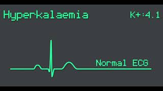 Flash ECG  Hyperkaliémie [upl. by Urdna]