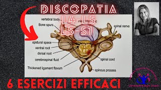 DISCOPATIA LOMBARE L4L5L5S1  6 ESERCIZI EFFICACI [upl. by Alwitt23]