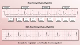 Advanced EKGs  Sinus Node Dysfunction [upl. by Tiffa]