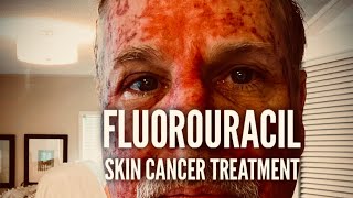 Fluorouracil Skin Treatment  Before During and After [upl. by Beetner263]