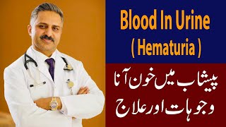 Blood in Urine  Hematuria  Causes amp Treatment [upl. by Lagiba186]