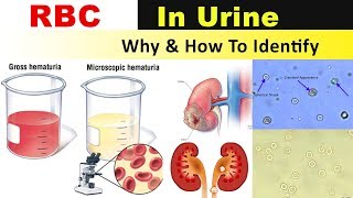 RBC In Urine  Why amp How to Identify [upl. by Anirbus]