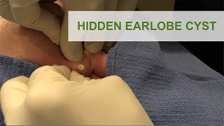 Penbrooks Ear Cyst Gets Popped [upl. by Sclater]