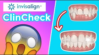 Invisalign Clincheck [upl. by Anya]