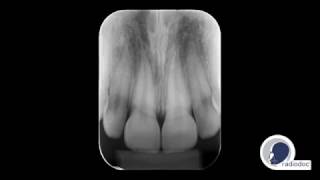 Radiografia Periapical  Radiodoc [upl. by Koy494]