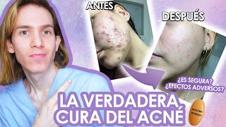 ROACCUTAN o ACCUTANE Efectos adversos como tomarla antes y despues LA VERDAD de la ISOTRETINOINA [upl. by Enasus]