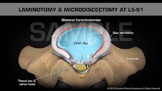 Laminotomy amp Microdiscectomy at L5S1 [upl. by Bainbridge]