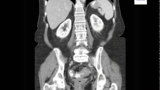 Diverticulitis on CT Scan [upl. by Anilac999]