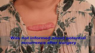 Chest Keloids  Mistakes to Avoid [upl. by Yecies]