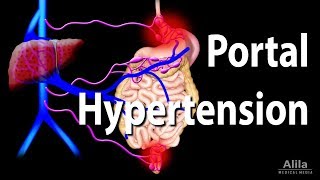 Portal Hypertension Animation [upl. by Bradney]