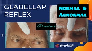 Glabellar Reflex  Myerson’s Sign reflexpathway cranialnerves positiveprimitivereflex neurology [upl. by Aterg]