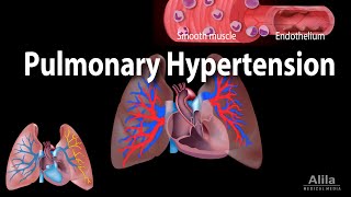 Pulmonary Hypertension Animation [upl. by Ojyllek]