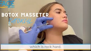 How to Inject Botox to the Masseter Muscles [upl. by Koetke649]