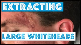 Acne Vulgaris and Extracting large Whiteheads  Part 1 [upl. by Cordle]