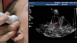 How To Transcranial Doppler [upl. by Karp]