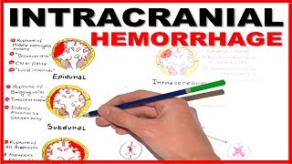 Hemorrhagic Stroke  Intracerebral Hemorrhage amp Subarachnoid Hemorrhage  Management [upl. by Chavey]