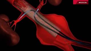 Fenestrated Endovascular Graft to Repair Abdominal Aortic Aneurysm [upl. by Oicirtap]