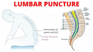 Lumbar Puncture Spinal Tap [upl. by Atnuahs]