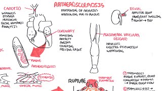 Atherosclerosis  Pathophysiology [upl. by Corson489]