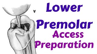 Lower Mandibular Premolars  Endodontic Access cavity Preparation Endodontic Lecture amp Tutorial [upl. by Treboh]