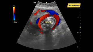 Umbilical Cord around Fetal Neck [upl. by Aiki]