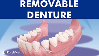 Removable partial denture © [upl. by Yrrol107]