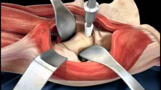 Hip replacement surgery techniques  Dr Scott Devinney [upl. by Hammond]