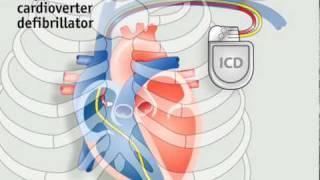 How pacemakers work [upl. by Naujid186]