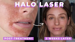 HALO LASER TREATMENT REVIEW  SKIN LASER [upl. by Adelbert584]