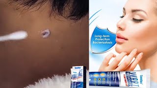 Instant Blemish Removal Gel  Sumifun Wart Remover [upl. by Wershba478]