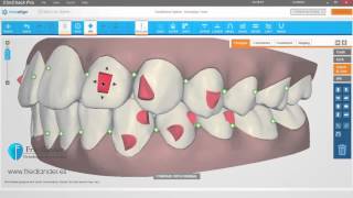 Invisalign ClinCheck Pro Tutorial planificación attachments  Ortodoncia Friedländer Barcelona [upl. by Toback]