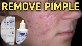 Remove pimples overnightClycinT lotion for acni removal and for Crystal clear skinjaveria sarib [upl. by Allain]