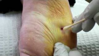 Surgical Plantar Wart Removal [upl. by Josefina]