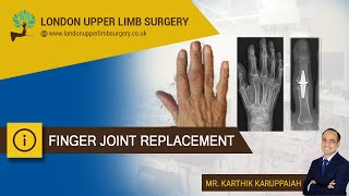 Finger joint replacement [upl. by Marylou]