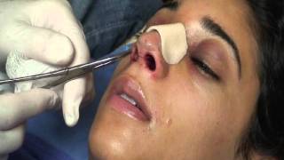 The Kotler Nasal Airway  Removal of the Airway [upl. by Kevon7]