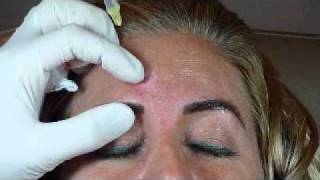 Glabellar Botox Injection Technique  Botox Class [upl. by Aztinaj]