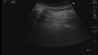 UltrasoundGuided Piriformis Muscle Injection [upl. by Aire]