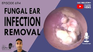 EAR INFECTION vs PERFECT EAR Inside Look  Dr Paul [upl. by Noitna]