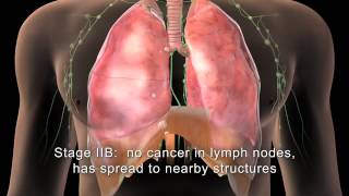 English MAKNA Getting to know Lung Cancer [upl. by Milas]