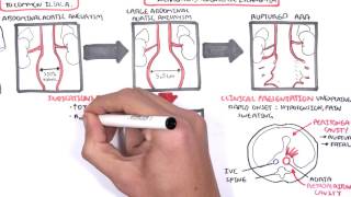 Abdominal Aortic Aneurysm AAA Ultrasound [upl. by Menendez]