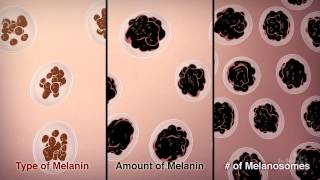 Melanoma  Overview signs and symptoms pathology risk factors treatment [upl. by Anegal]