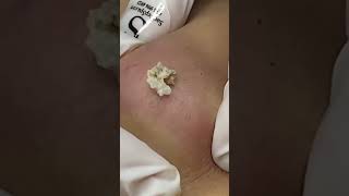 Big Cystic Acne Blackheads Extraction Blackheads  Sac Dep Spa shorts [upl. by Nizam]