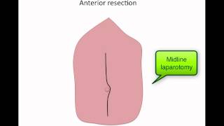 Basics of colorectal operations [upl. by Elfrieda181]