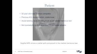 Meniscus Tears  Everything you need to know [upl. by Andrea]