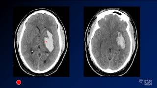 Glioma Brain Tumors Surgical Therapies and Current Genetic Studies [upl. by Noemi]